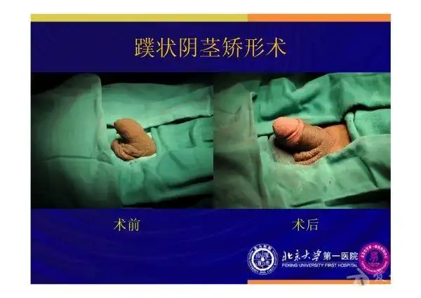 2012北京男科论坛(十六)——袁亦铭-男科手术的现状与治疗 - 泌尿及生