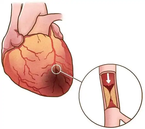 心梗救治日,专家教你两个"120"