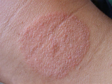 足,毛发,甲板以及阴股部以外的皮肤)所引起的浅表性皮肤真菌感染,是