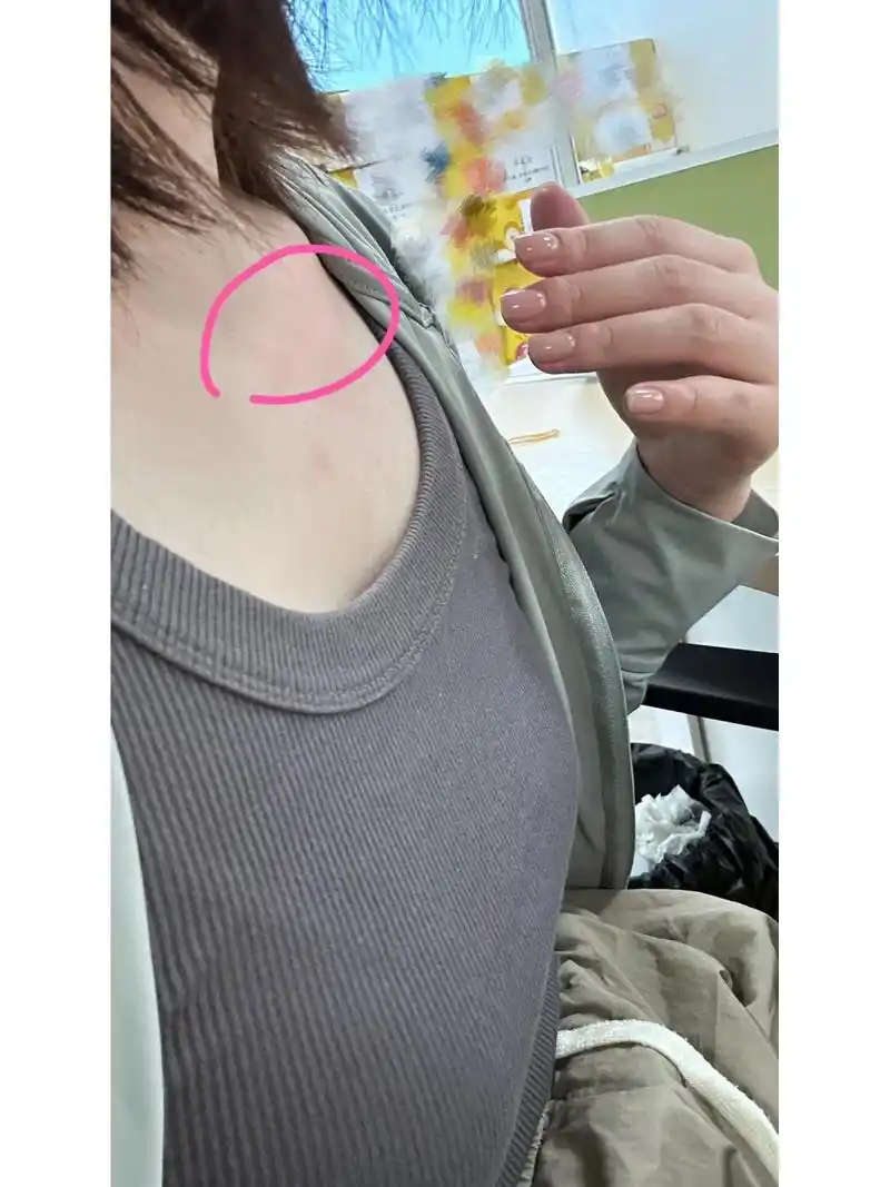 右边锁骨下面突然凸起了一块 右边锁骨下突然凸起一块,不痛不痒,这是