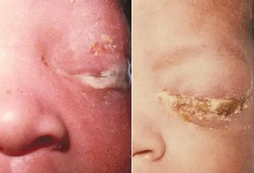 图文并茂:性传播感染的特征之淋病_性传播感染_淋病_性传播疾病_医脉