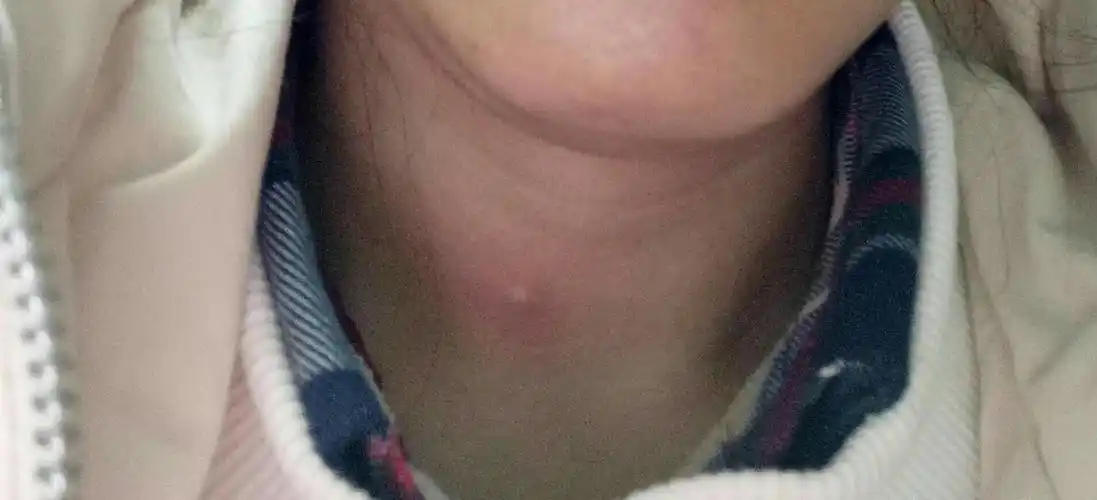 脖子上起了一个小疙瘩,摸上去有些硬硬的