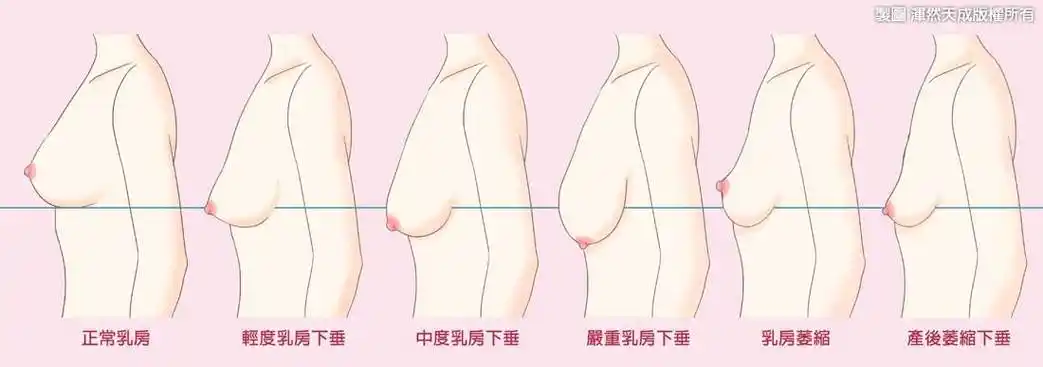 产后,下垂,乳房,松,垂,软,外扩,紧实,紧致,双峰,胸部,变形,妈妈,老化
