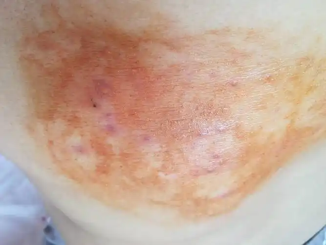 身上起了蛇蛋疮有一星期了,特别疼,涂墨水,涂药膏,吃药都没什么效果