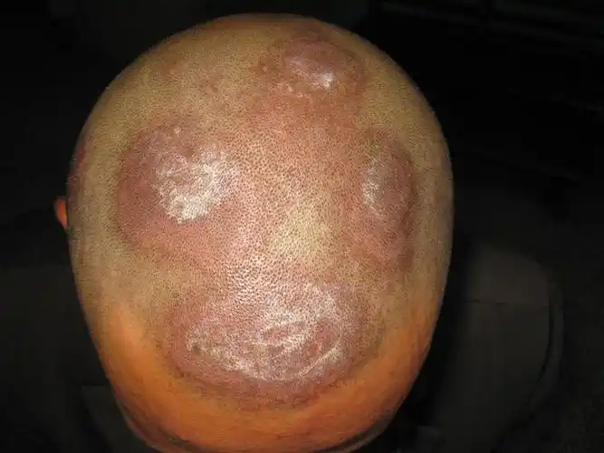 看图识病———头皮银屑病