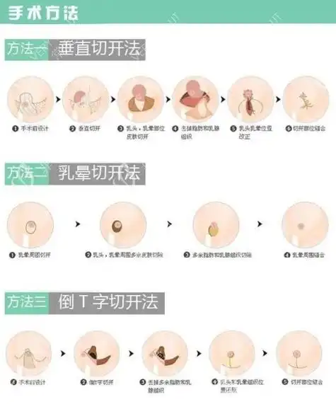 乳房悬吊术手术方法示意图