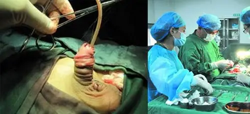 婴幼儿先天性尿道下裂去哪里治疗好