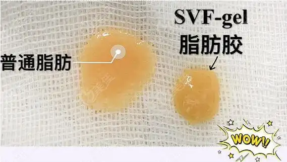 南昌脂肪填充脸哪家好,听说这家医院做自体脂肪胶填充全脸有专用技术