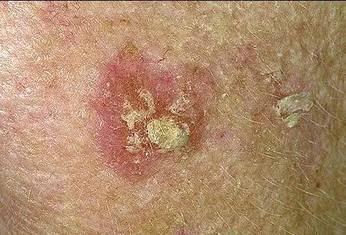 看图识病各种皮肤癌及癌前病变的不同表现