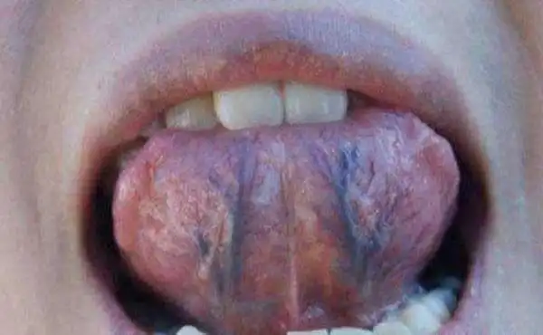 舌下青筋是正常的组织静脉,出现明显的青筋当然不是说所有的情况都是