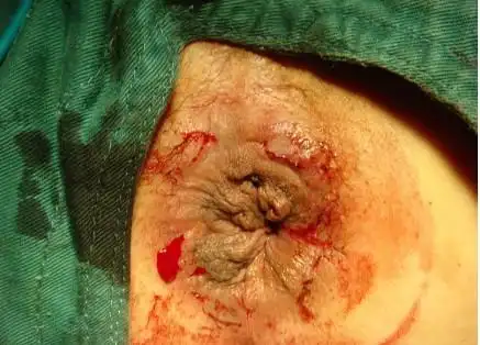 外痔疮图片女性早期图片大全_有来医生