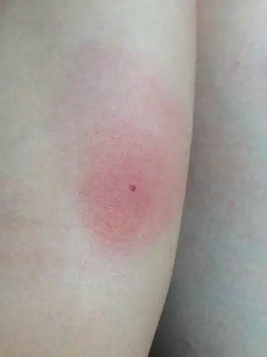 被蚊子咬后这样.