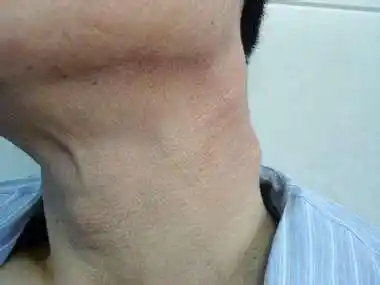 【淋巴肿大】艾滋病淋巴结肿大当心为初期症状