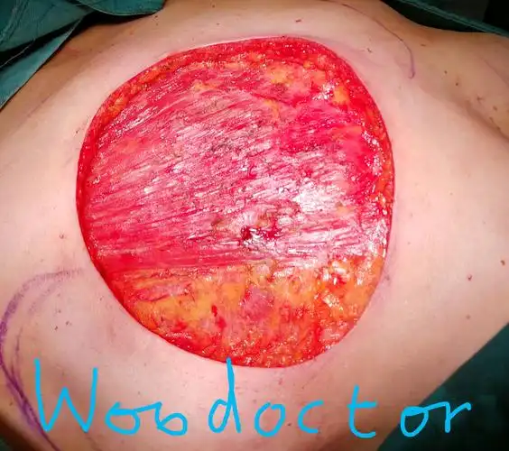 局部晚期巨大乳腺癌肿的手术