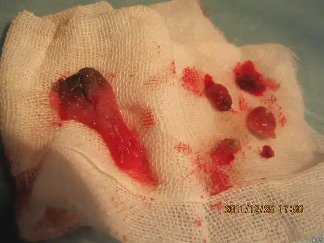 第十七例剥扎六处的环状静脉曲张混合痔术前术后逐渐愈合图手术方式