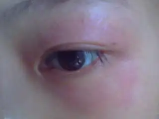 眼睛周围很红,怎么办.