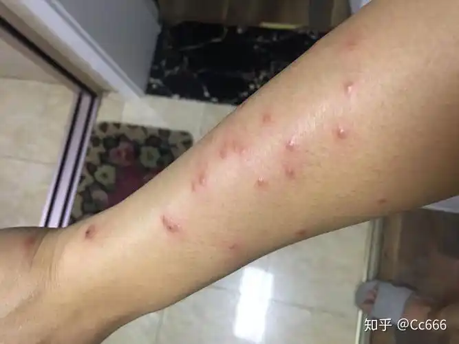 丘疹性荨麻疹如何治疗?