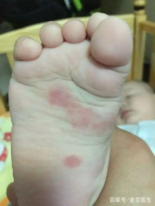 手足口病高发期,家园携手做好预防工作!