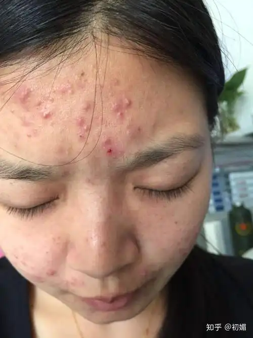 初媚脸上的痘痘一直不消到底如何是好