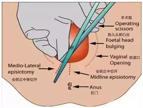 分娩侧切不用怕,产后护理好,伤口恢复超级快!