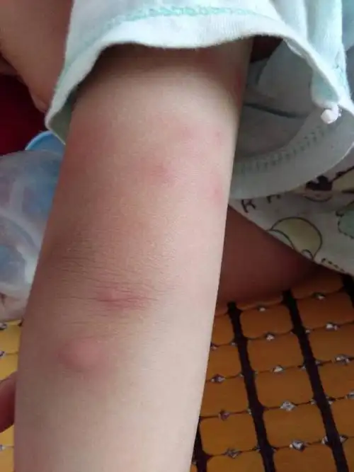 家里两周岁宝宝全身起这种红疙瘩,起起落落,最后成痘印.说是过敏