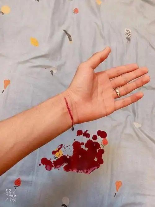 求大神p一个手腕流血包扎好的照片,在线等