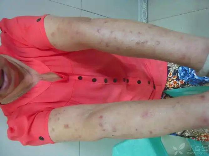 皮疹在四肢和头面部,痒.要好的治疗方法吗