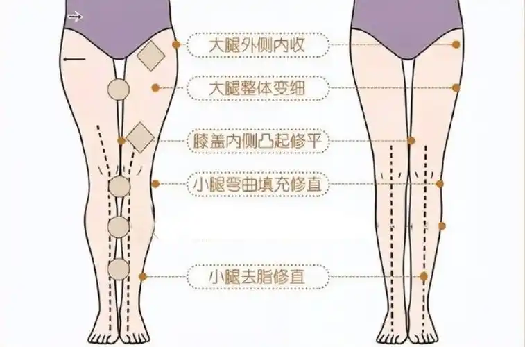 北京圣嘉新李春财直腿术怎么做大腿吸脂能让腿变直吗