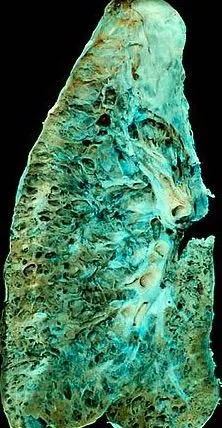 关于肺间质纤维化,您了解多少?