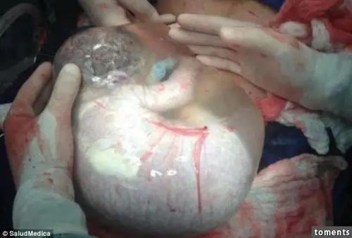 带著"完好羊水囊"出生的宝宝,医生都惊呆了!