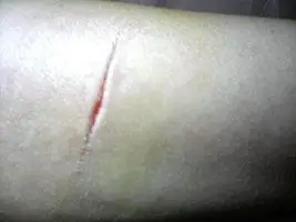 别被划伤怎么处理 路边被划伤保险