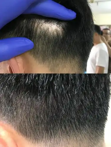 早期植发遗留在后脑勺的一条疤痕纹发有危害吗?