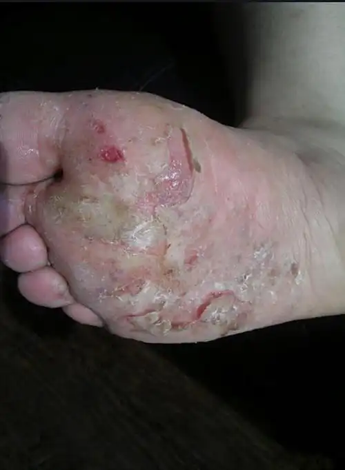 去脚气原来这么简单!白花冤枉钱了!