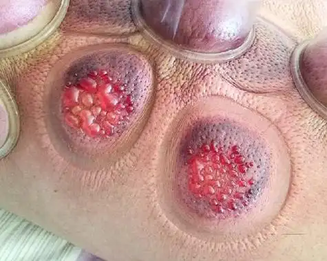 拔罐出的水泡如何处置