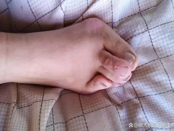 拇外翻合并其余趾头畸形,仰趾和叠趾