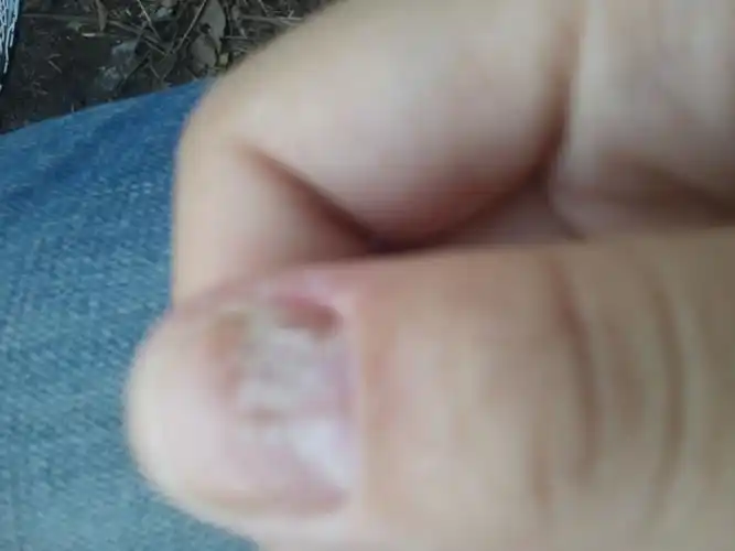 大拇指指甲表面两个月前出现了白色的东西后来越来越多怎么治疗