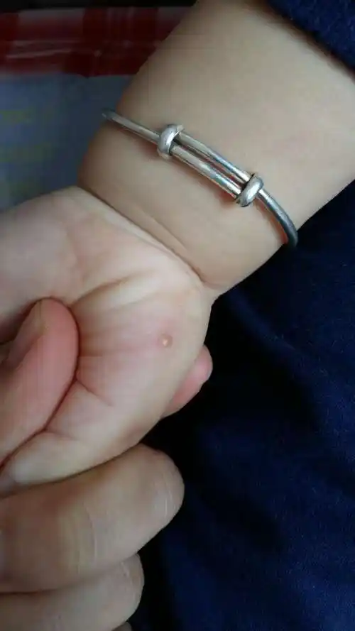 一岁半宝宝手上有个小水泡,第一张是蚊子咬的,过了两天就变成小的水