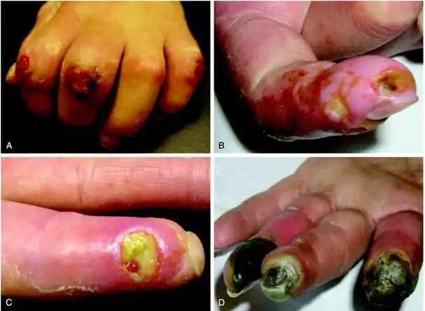 你对硬皮病了解多少