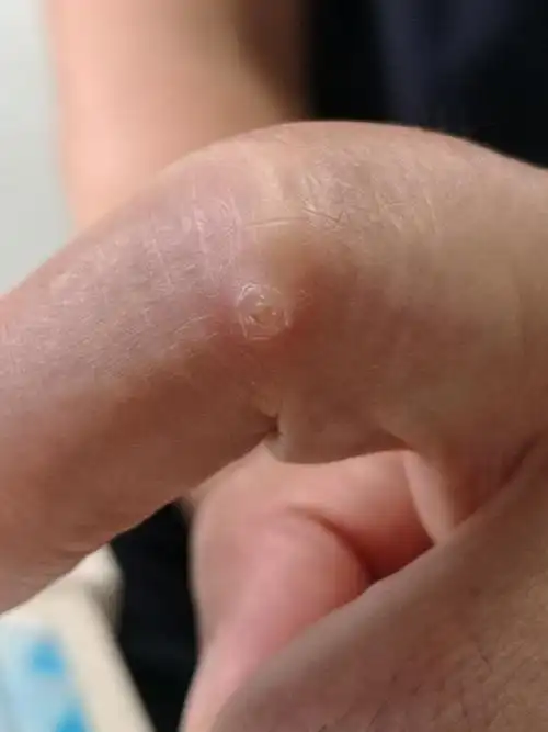 考虑寻常疣.可以使用激光治疗配合药物涂擦治疗祛除.