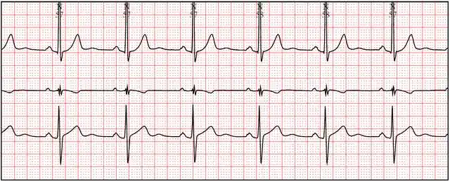 发现患者的心电图波形在大部分时间均为正常,但有两次持续2-3分钟的
