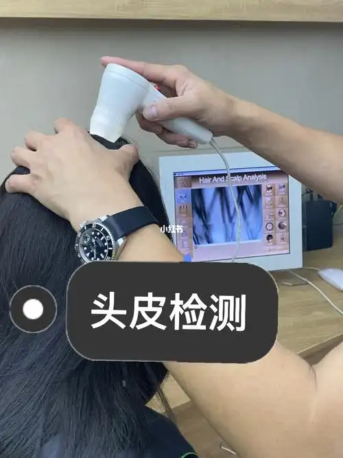 头皮检测