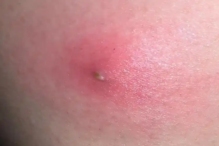 火疖子成熟的图片