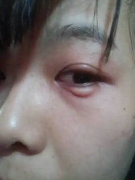 收拾旧物时,眼睛突然肿了,以为是进了汗水,哪知道原来长了个包,肿了!