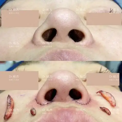 鼻翼疤痕修复切除