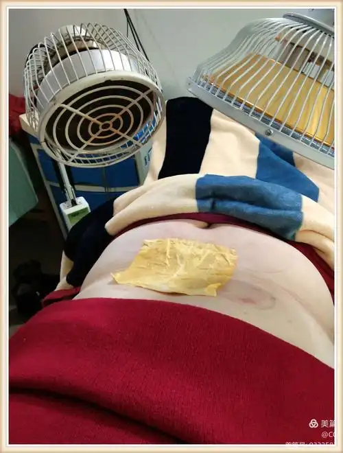 腰痛中药贴敷治疗