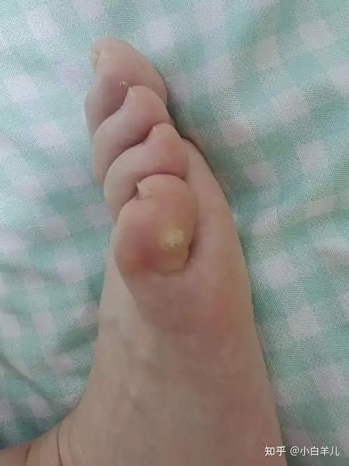 分享一个跖疣治愈的过程 - 知乎