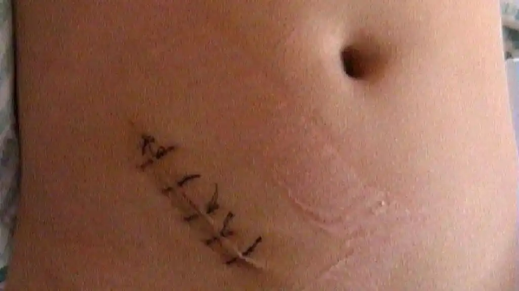 腹腔镜微创阑尾切除与传统阑尾切除 - 抖音