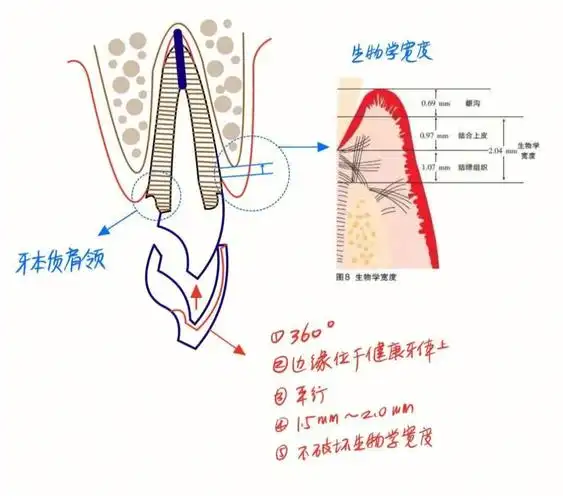桩核冠 牙本质肩领 生物学宽度*一直没搞明白"箍效应"到底是什么意思