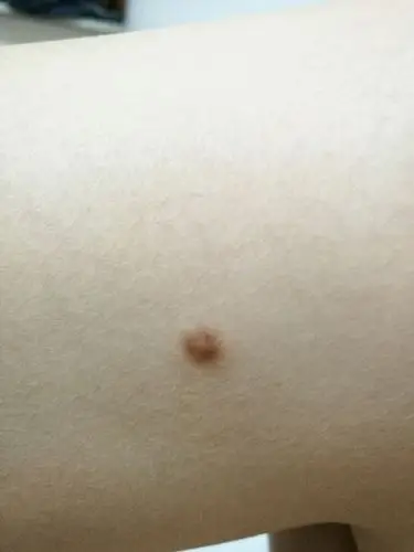 小腿内侧长了黑色小疙瘩,有黄豆大小,有好几年了.