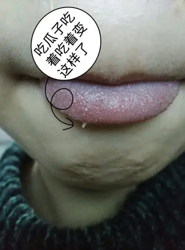 吃瓜子吃完,舌头的味蕾变大了,凸起来,好难受,扯它凸起的味蕾会疼,不